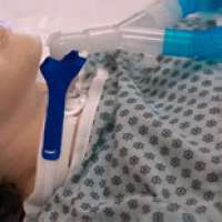 Pediatric Vent Circuit Anti-Disconnect Device Product Image